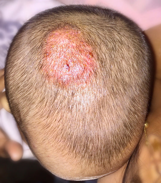 Ringworm in hair